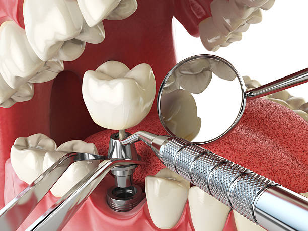 Best Emergency Root Canal Treatment in Glen Alpine, NC